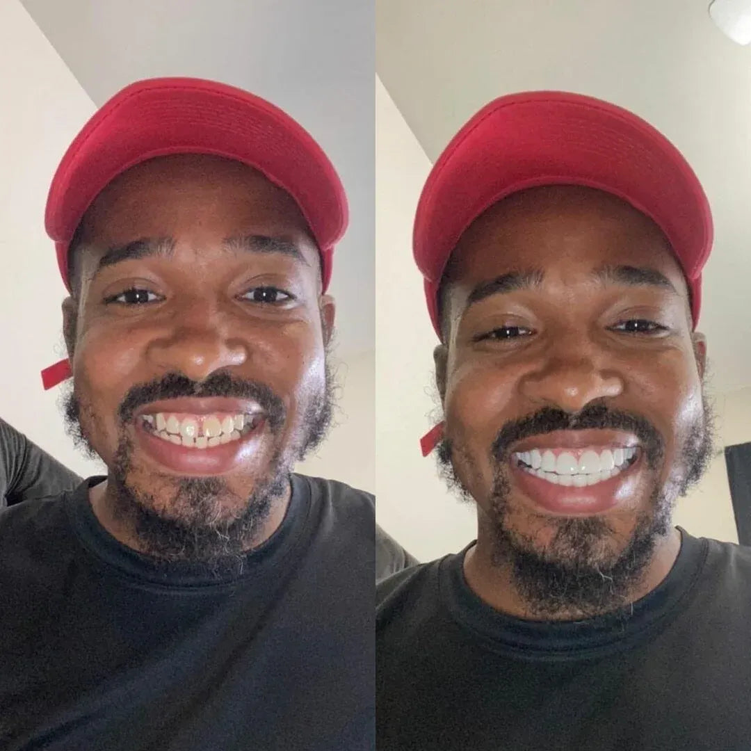 Avelora™ Clip-On Veneers