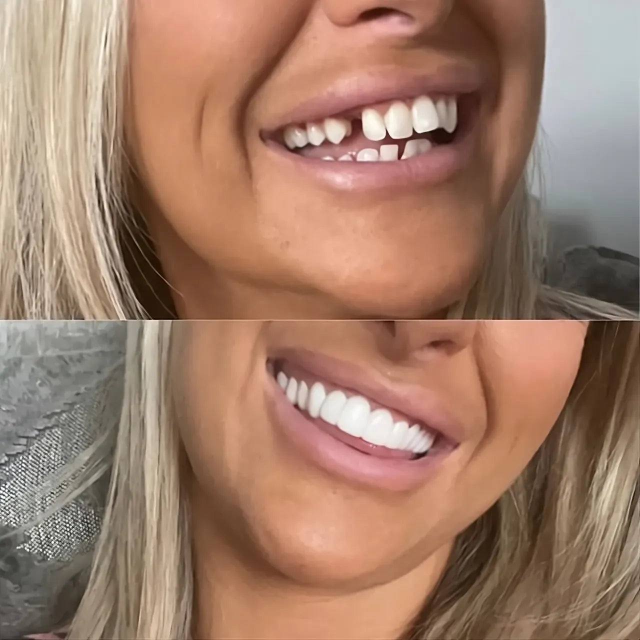 Avelora™ Clip-On Veneers